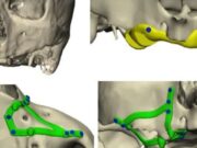 La implantologia moderna permet rehabilitacions fixes en casos complexos sense regeneració òssia