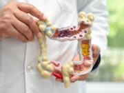 El càncer de còlon és en gran part prevenible amb canvis d’estil de vida